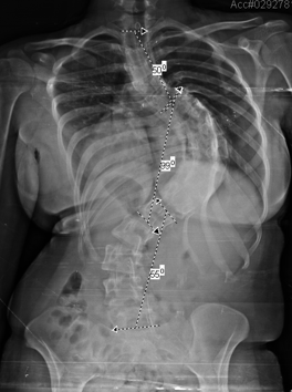 Escoliose degenerativa do adulto - Principais complicações - Dr