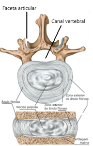 Degenera O Discal E H Rnia De Disco Dr Guilherme Costa