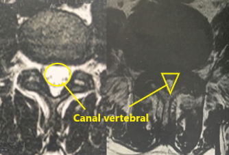 RM axial lombar - estenose x normal
