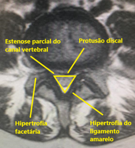RM axial lombar estenose - hipertrofia ligamento amarelo + hérnia discal
