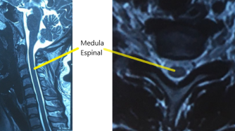 RM cervical medula espinal