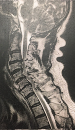 RM sagital cervical – estenose do canal vertebral