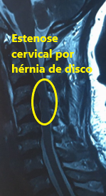 RM sagital cervical – estenose por hérnia de disco