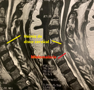 RM axial lombar estenose - hipertrofia ligamento amarelo + hérnia discal