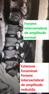 RM sagital lombar - estenose foraminal