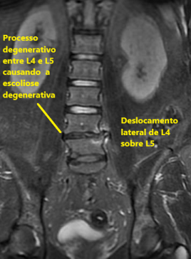 Escoliose degenerativa do adulto - Principais complicações - Dr