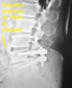 RX sagital lombar com osteófito – bico de papagaio