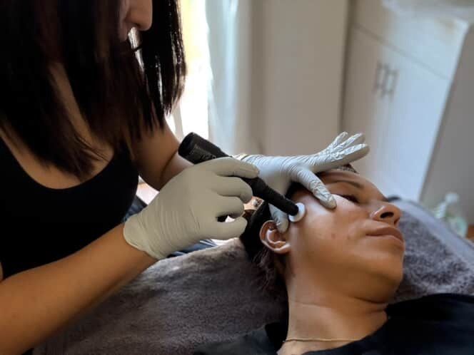 Facial microneedling treatment: A person's face being treated with a handheld device by someone wearing gloves in a clinic.