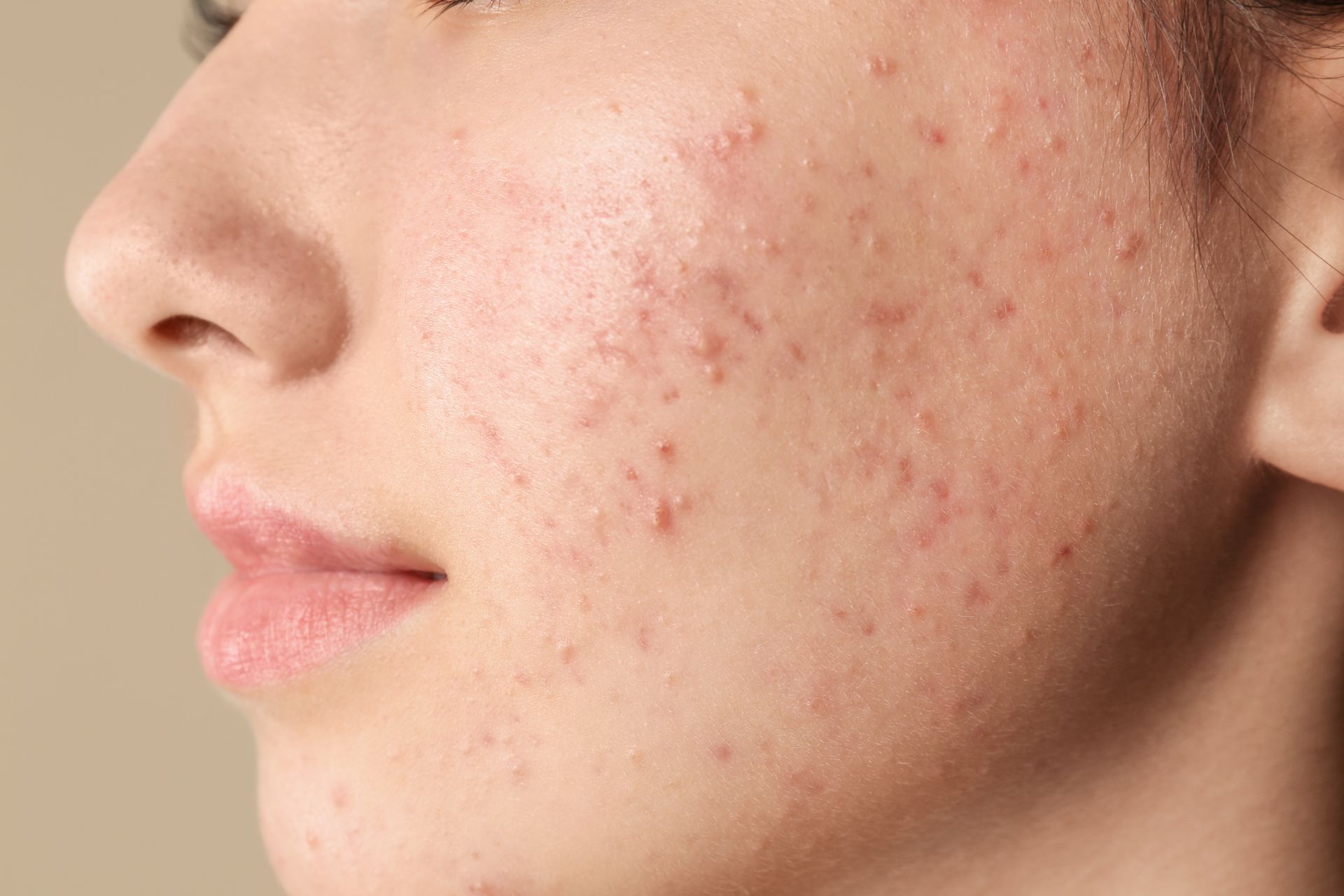 Close-up of a person's cheek with multiple red acne blemishes.