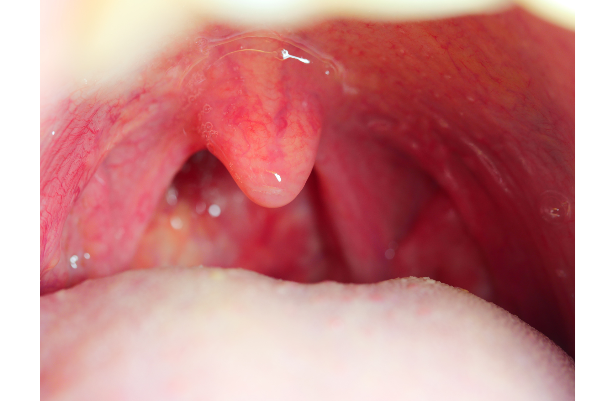 Health complications Tonsillitis