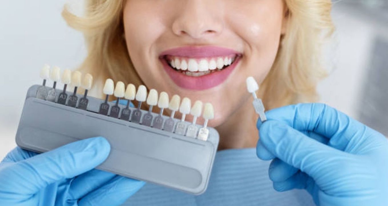 The Essential Guide to Veneers in Colombia