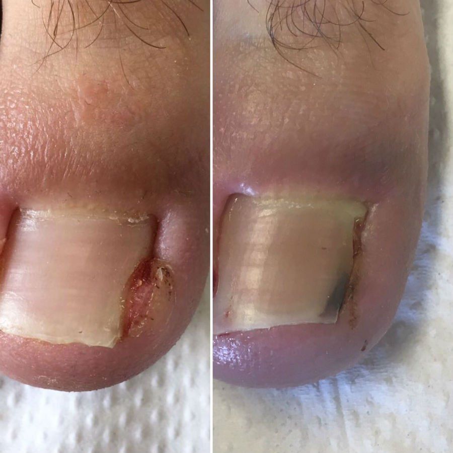 ricostruzione unghie