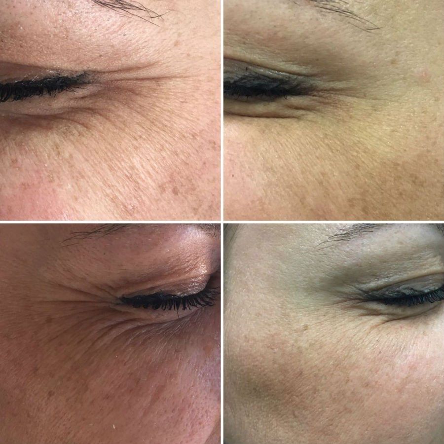 lifting zampe di gallina