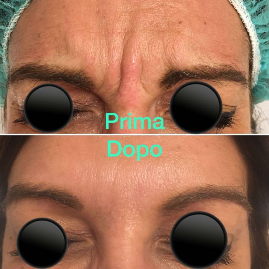lifting rughe prima e dopo
