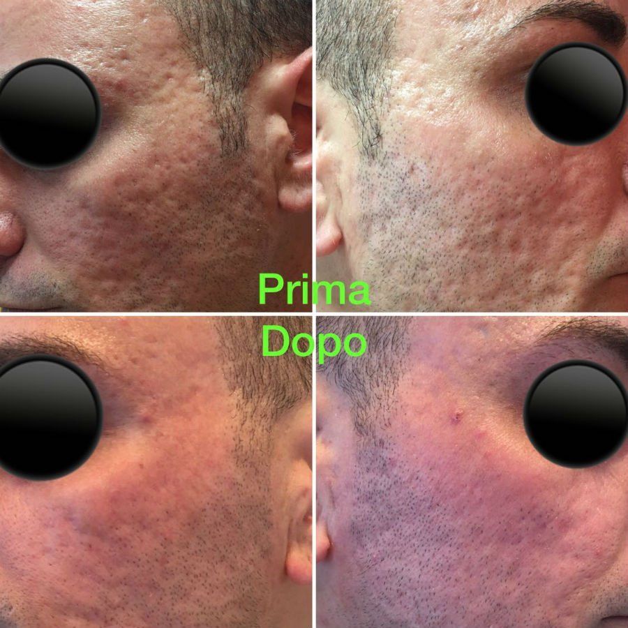 peeling effetto prima e dopo