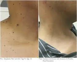 A before and after photo of a person 's neck and chest.