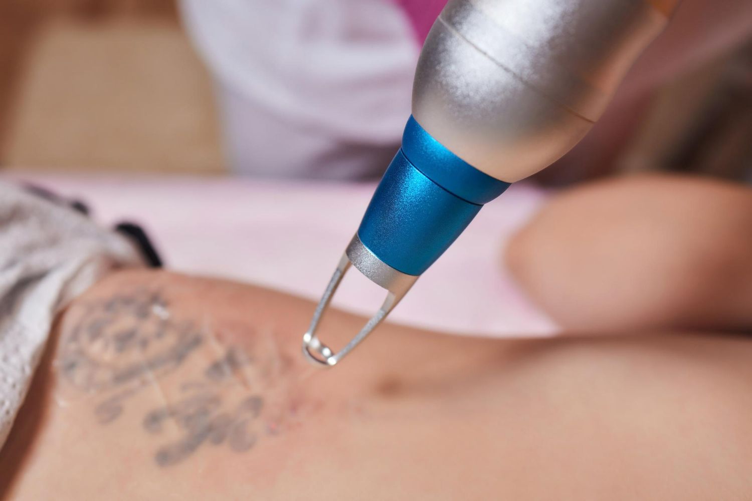 Laser tattoo removal in progress; laser device pointed at skin with fading black tattoo.