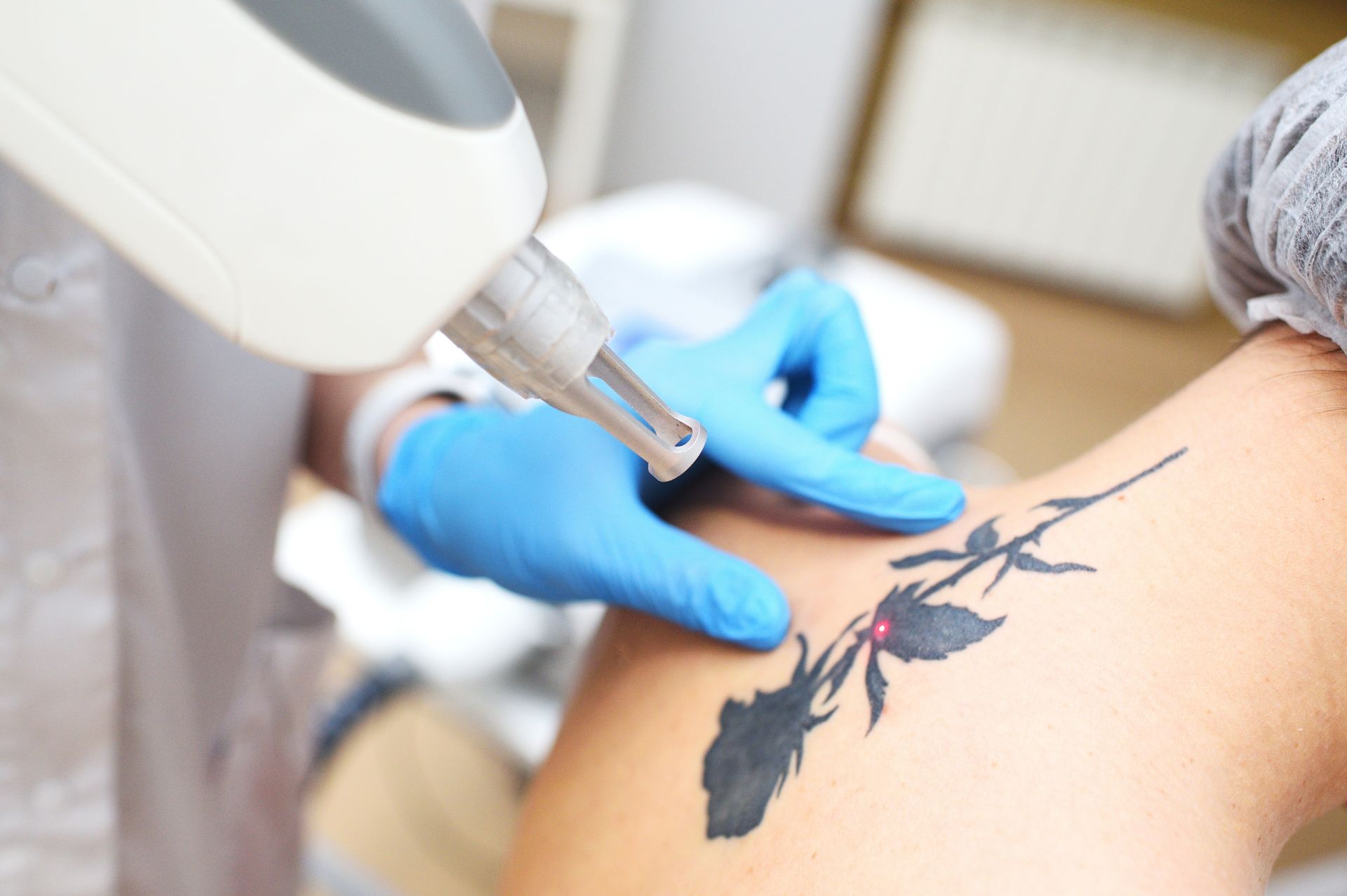 A person is getting a tattoo removed from their arm.