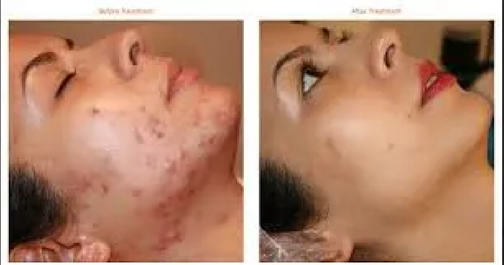 A before and after picture of a woman 's face with acne.