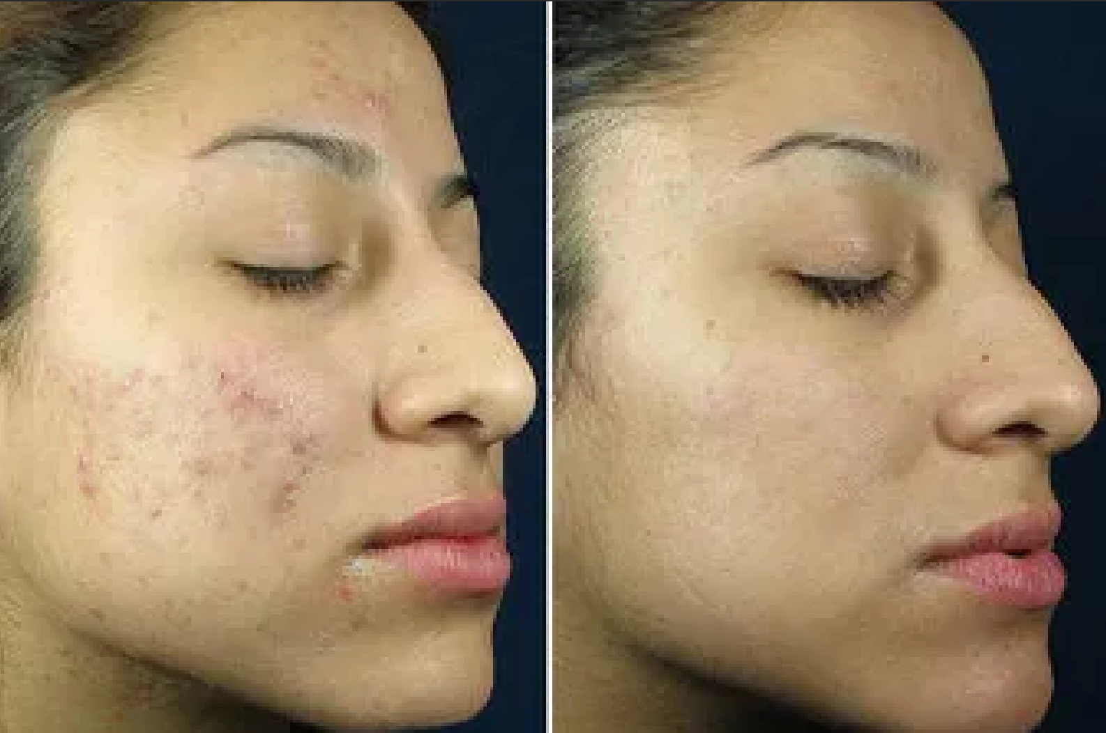 A before and after picture of a woman 's face with acne.