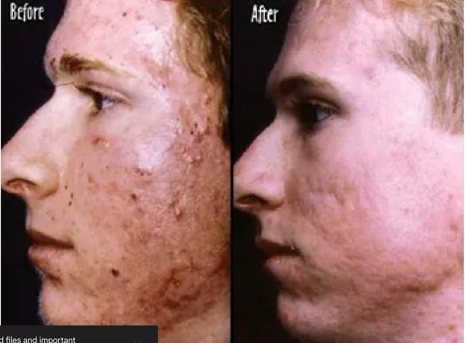 A before and after photo of a man 's face with acne.