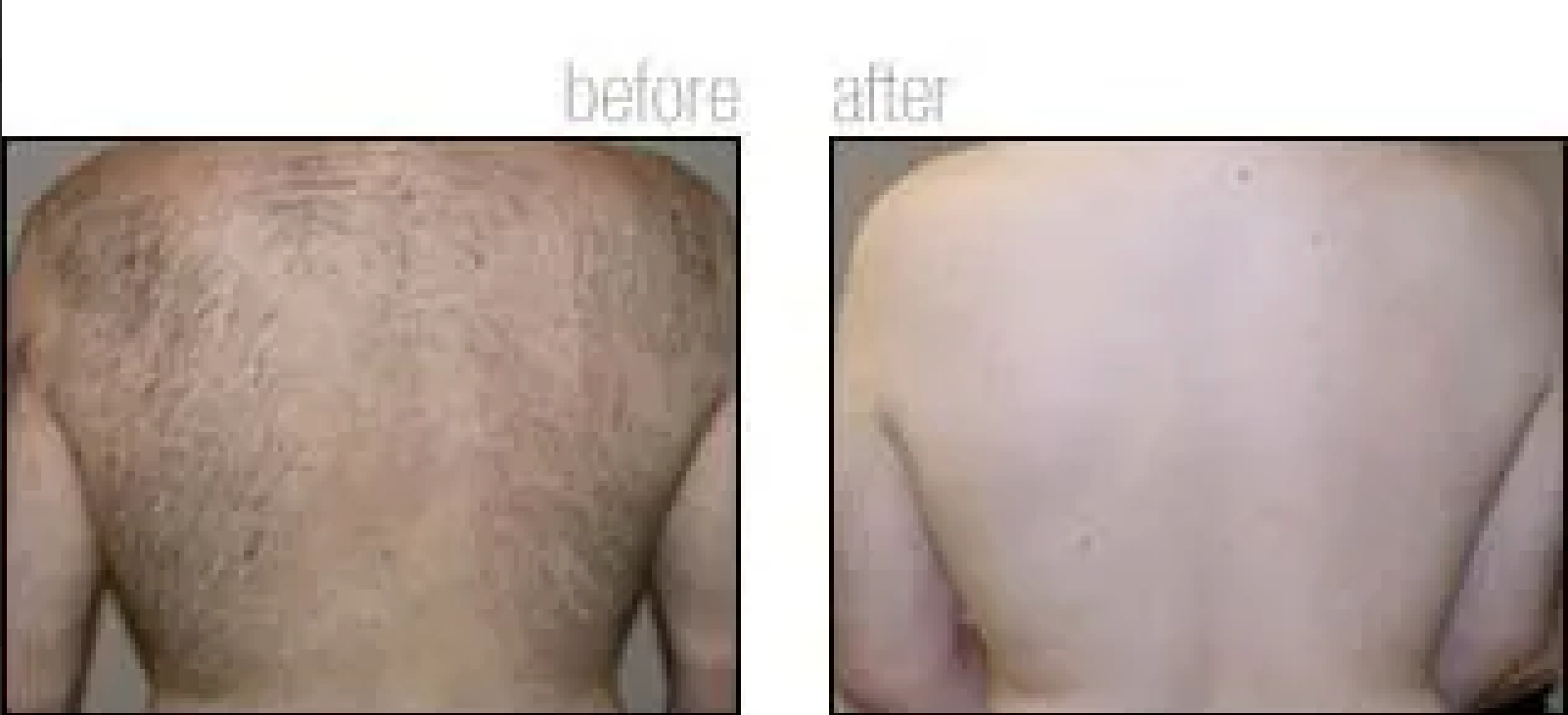 A before and after picture of a man 's back.