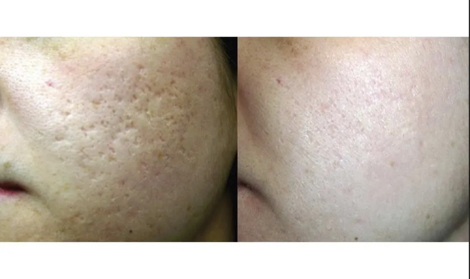 A before and after photo of a woman 's face with freckles.