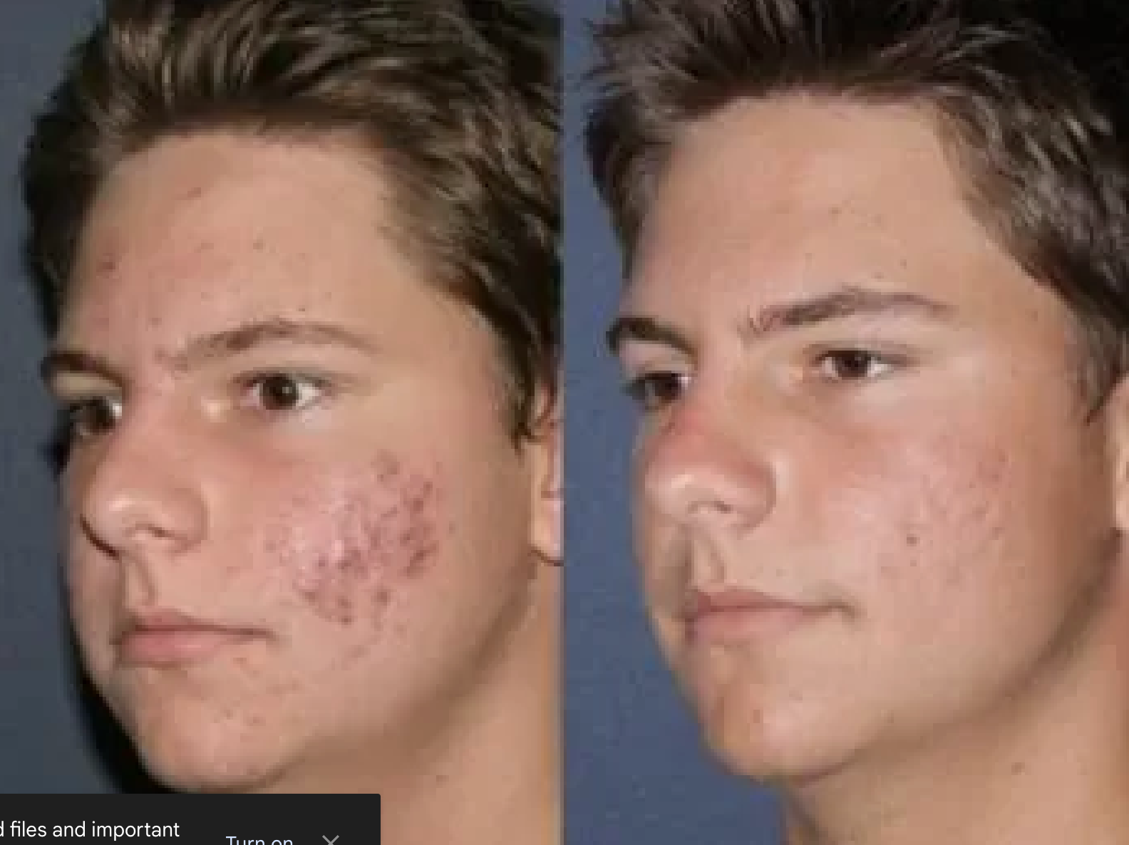 A before and after photo of a young man 's face with acne.