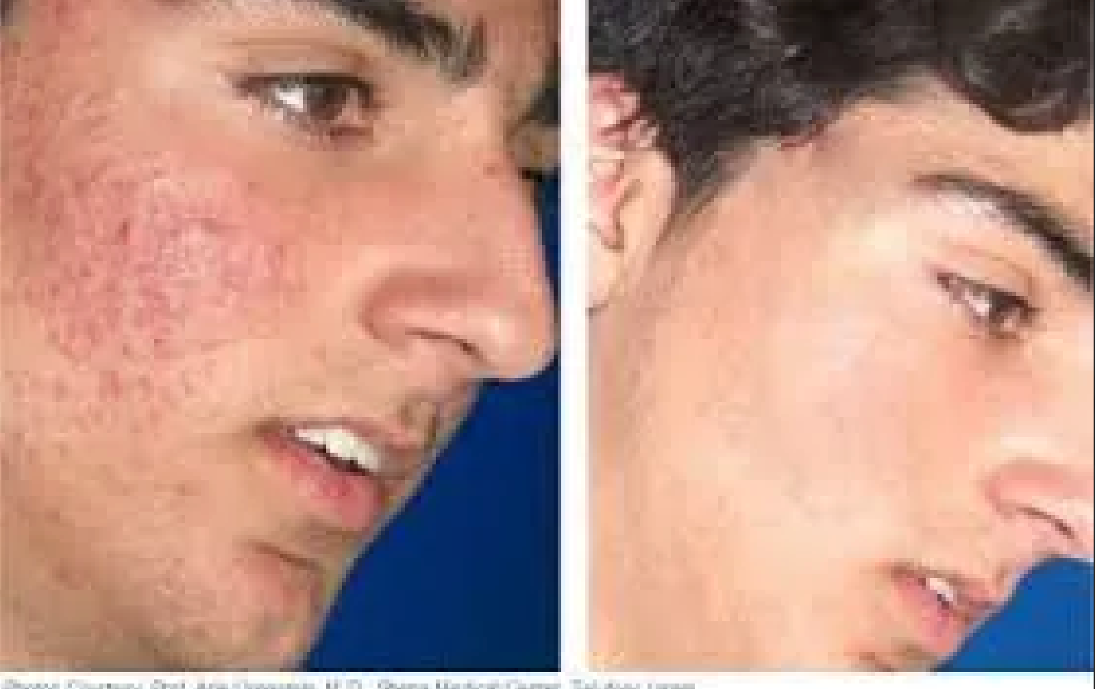 A before and after picture of a man 's face with acne.