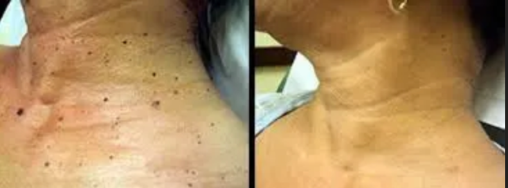 A before and after photo of a woman 's neck and chest.
