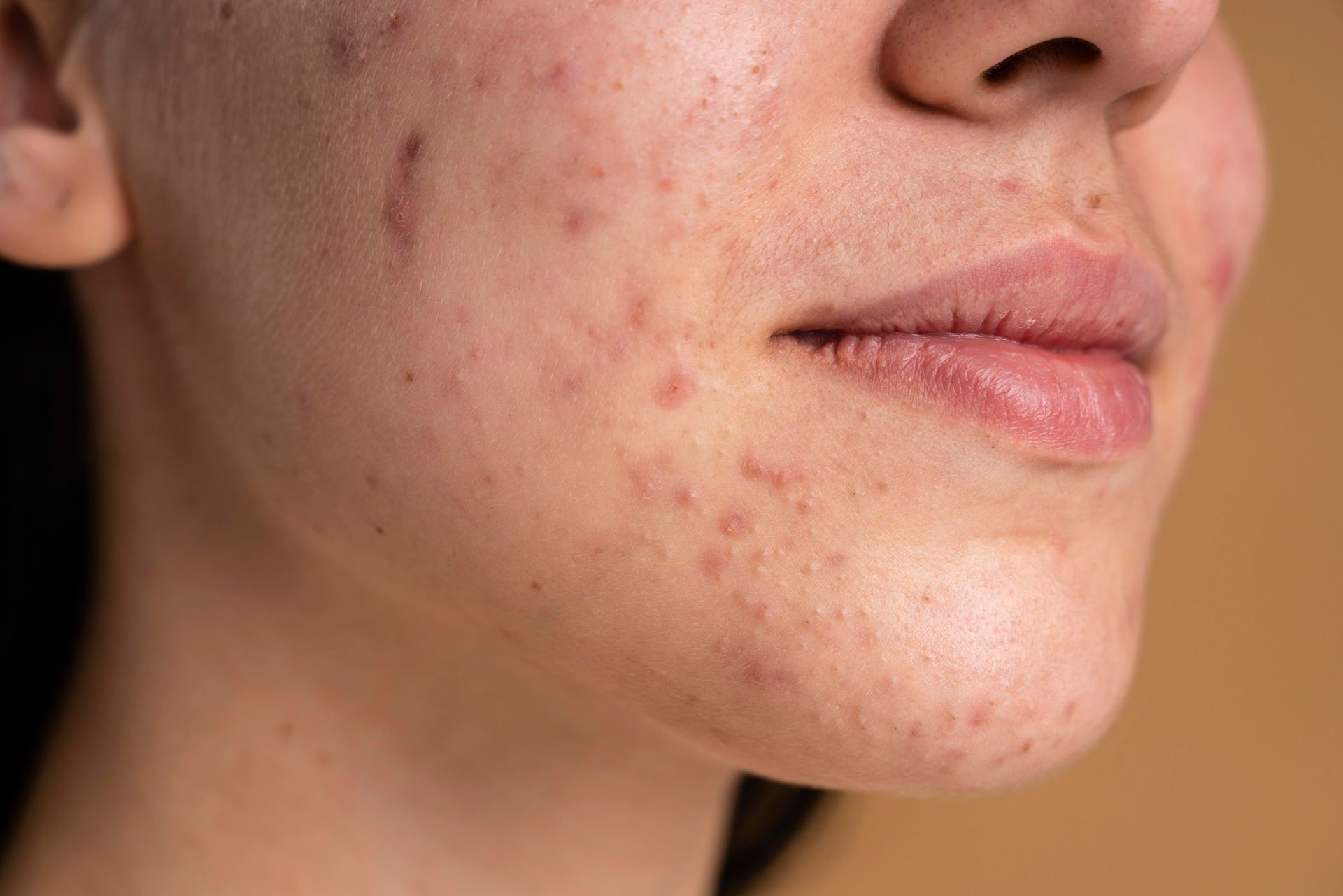 Close-up of a person's face showing skin with acne and scars, against a neutral background.
