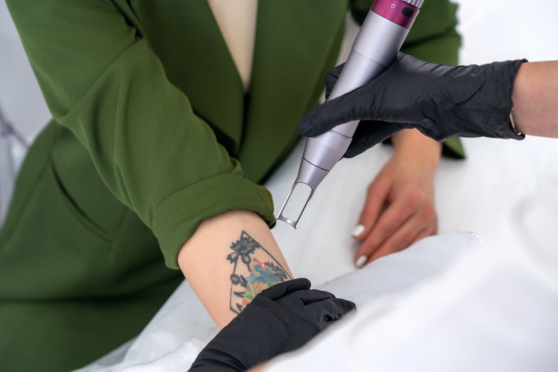 A woman is getting a tattoo removed from her arm.