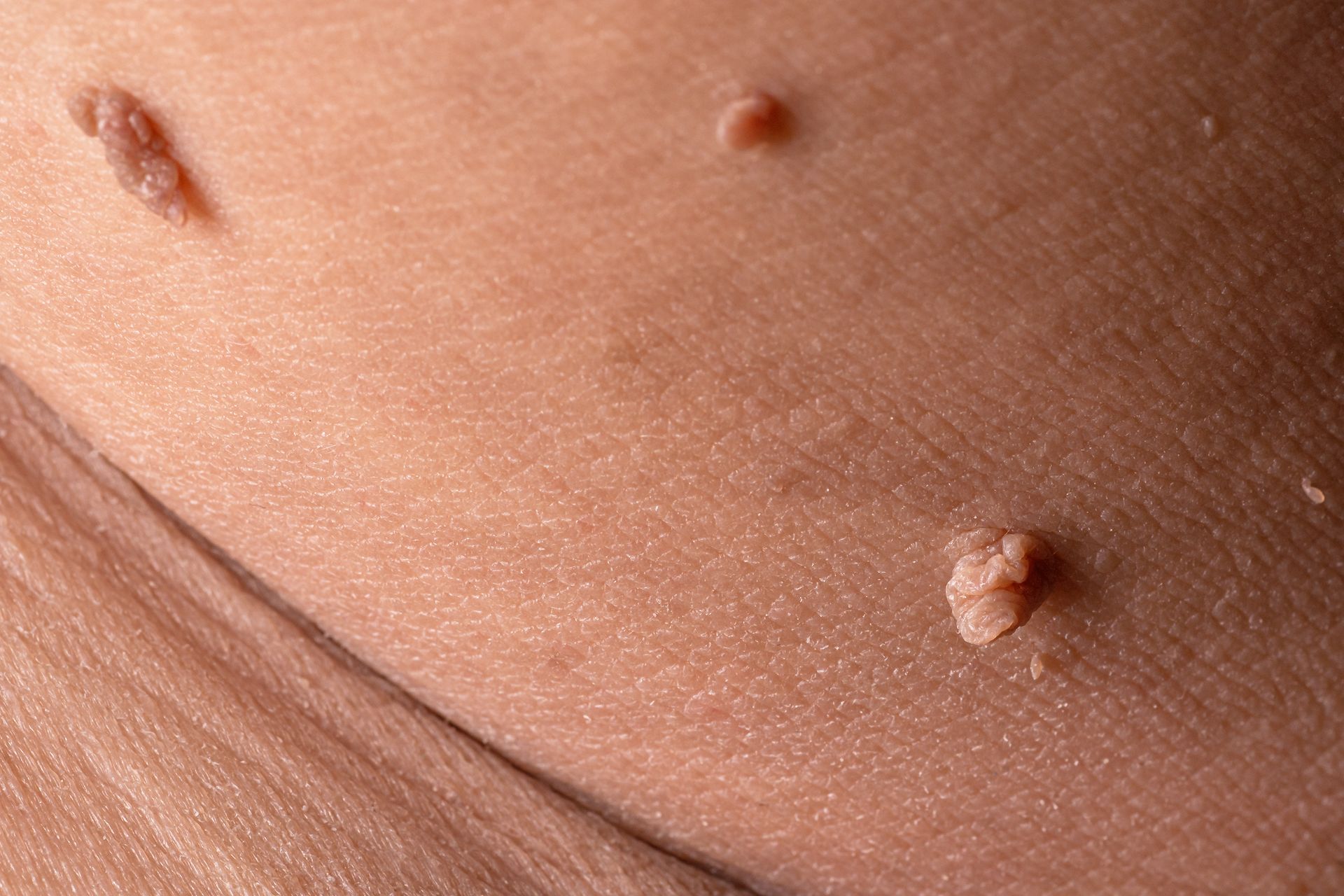 Skin with several small, raised, tan-colored growths, possibly skin tags or warts.