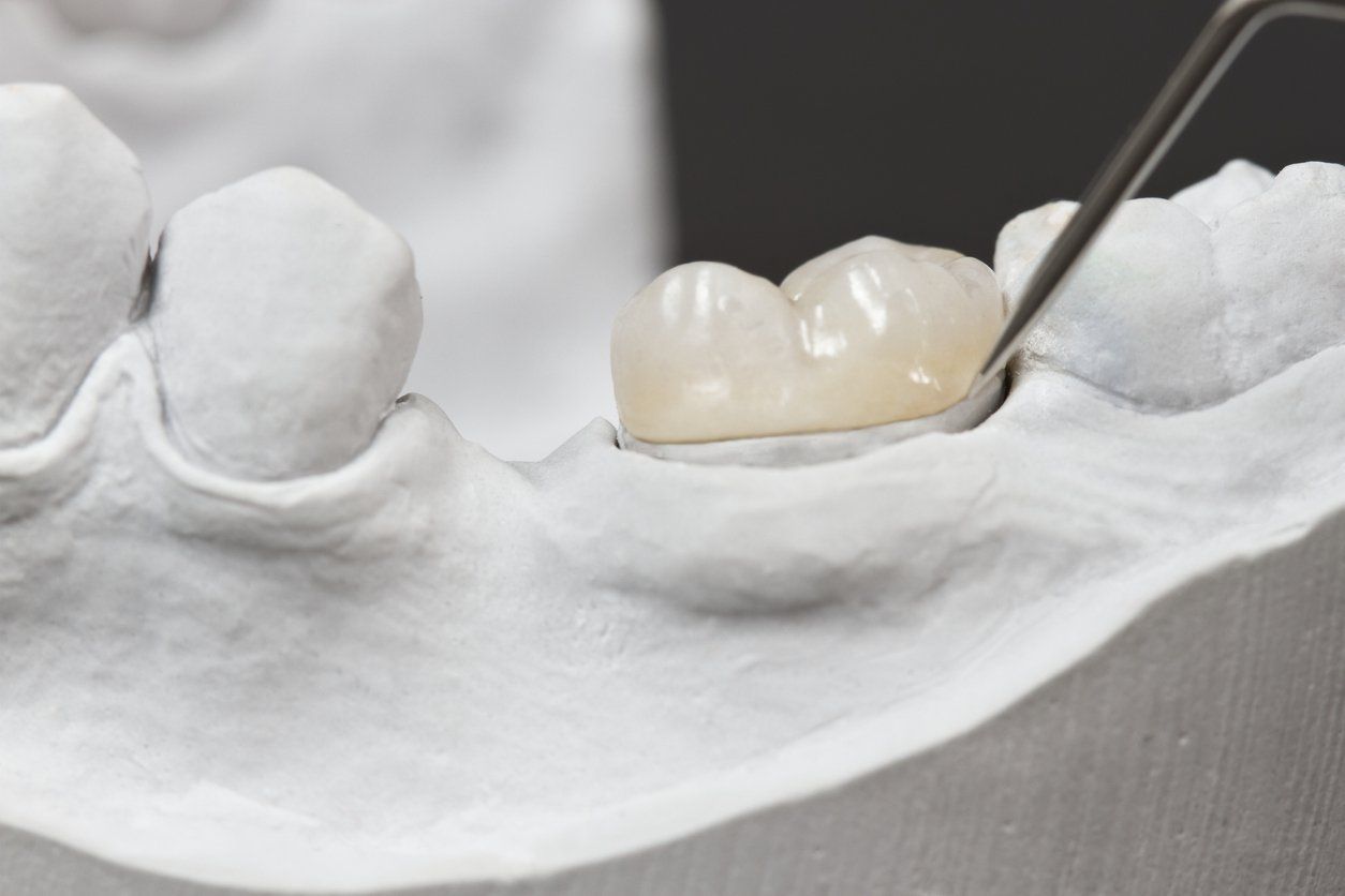 3d imaging being used to create a model of teeth