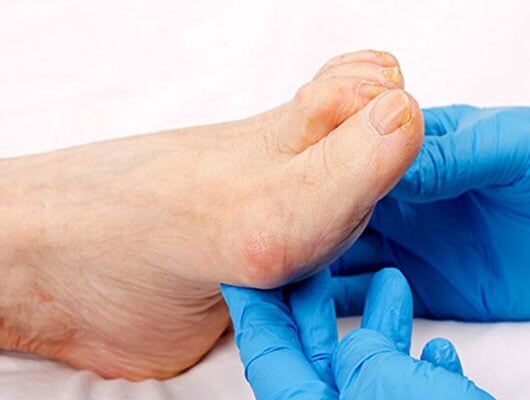 A patient receiving diabetic foot treatment in Monmouth County, NJ