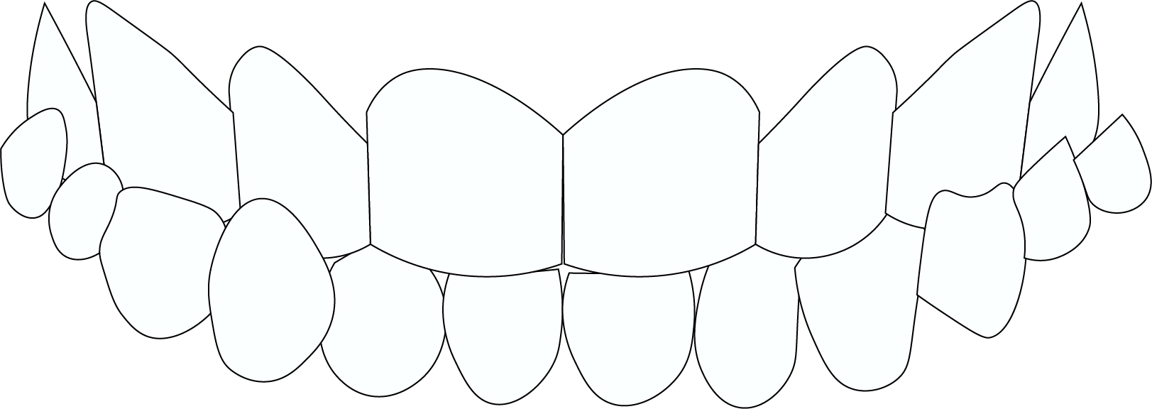 Cross bite