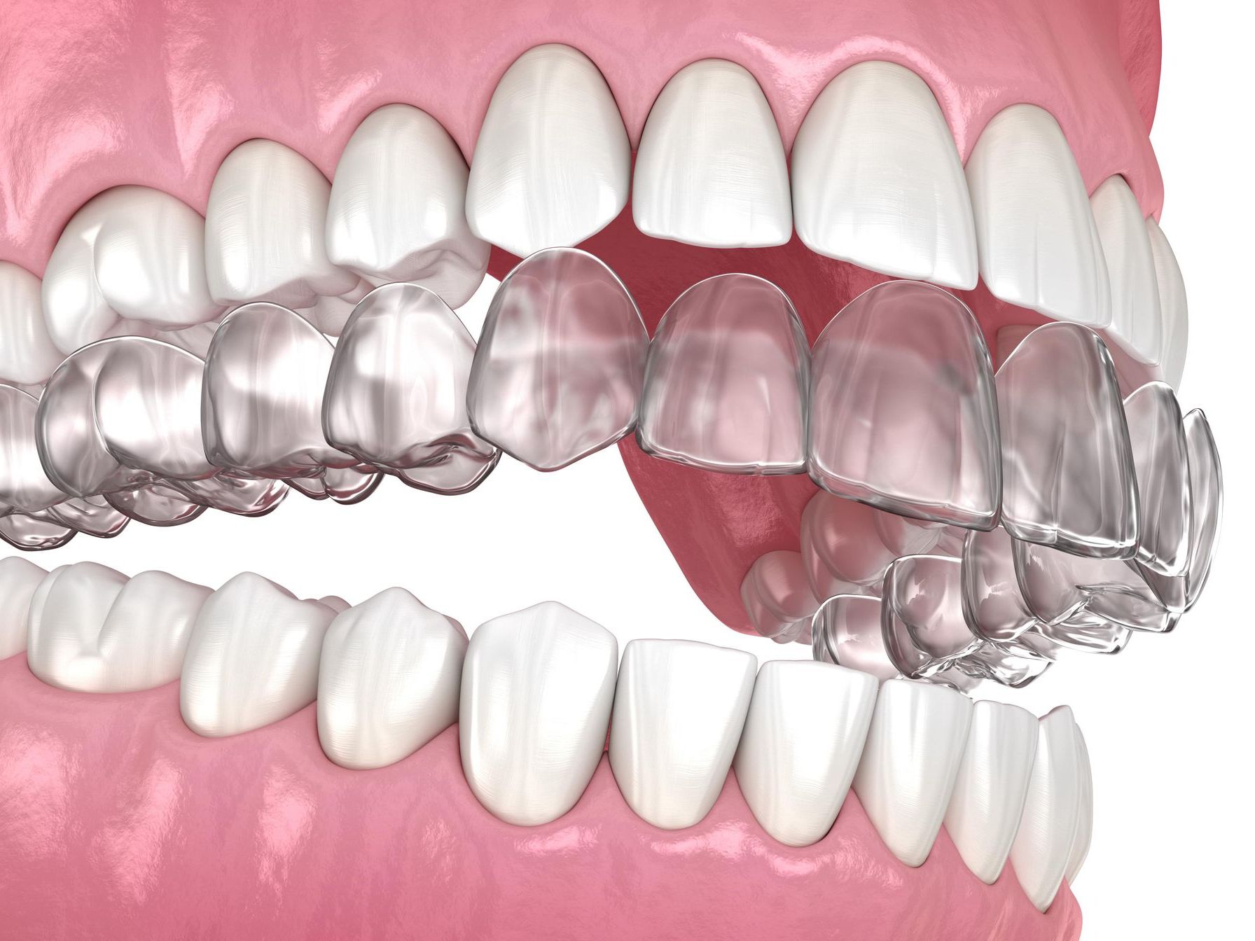 A computer generated image of a set of clear aligners on teeth