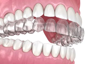 Clear aligners