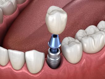 Dental implants