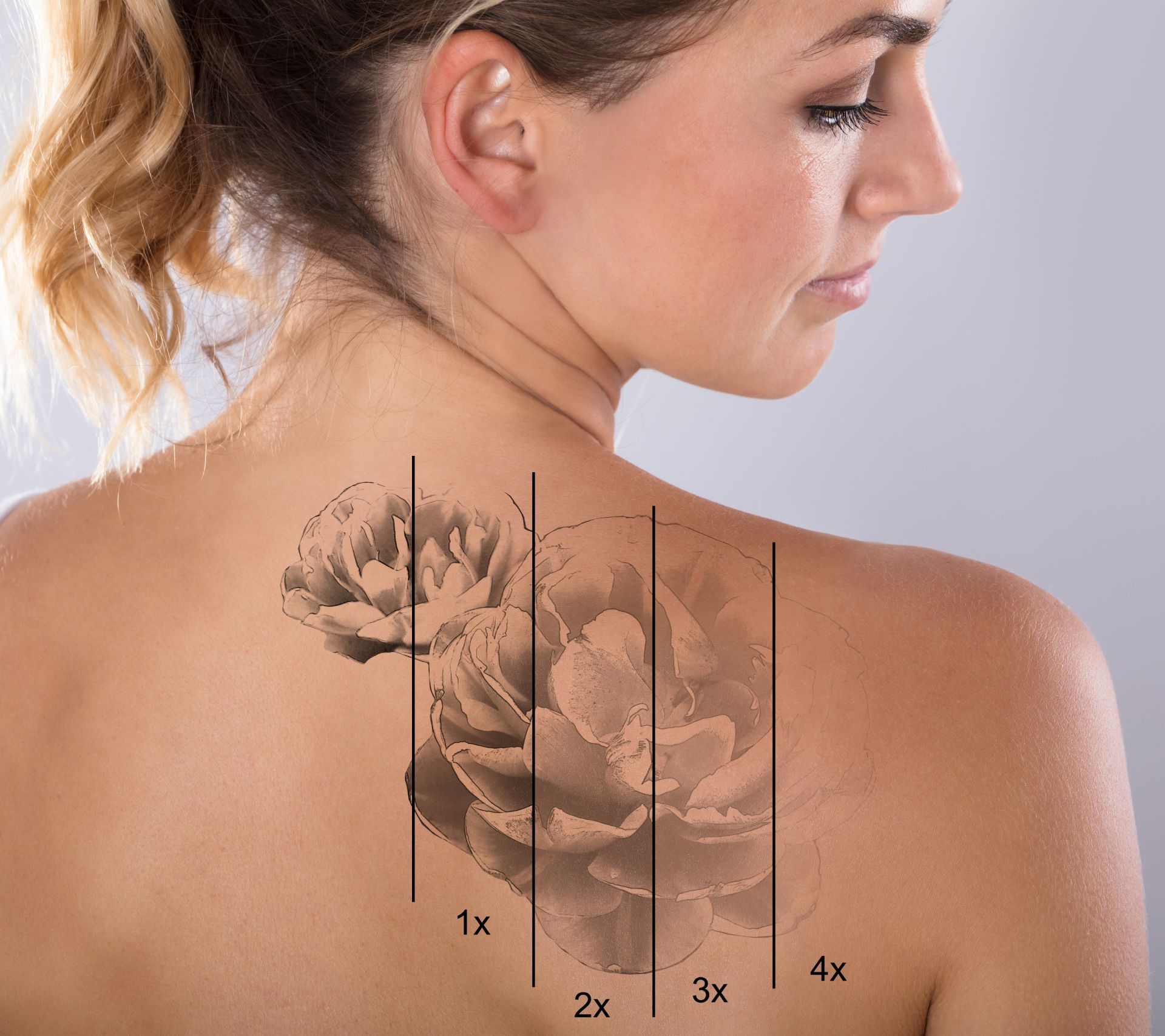 Woman's back with a flower tattoo marked for laser removal sessions 1x-4x.