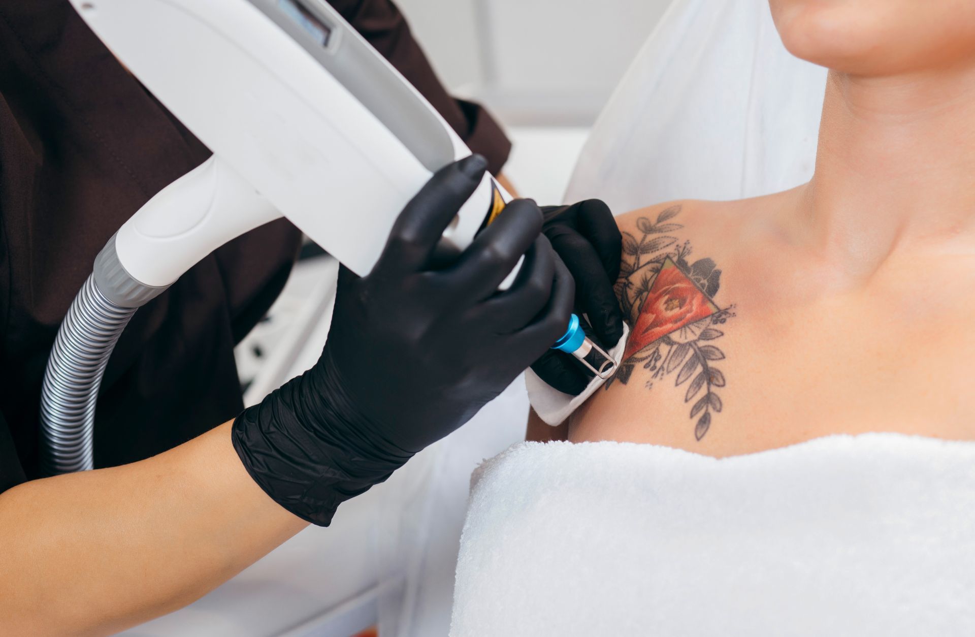 Laser tattoo removal on a person's chest, operator in black gloves, floral tattoo visible.