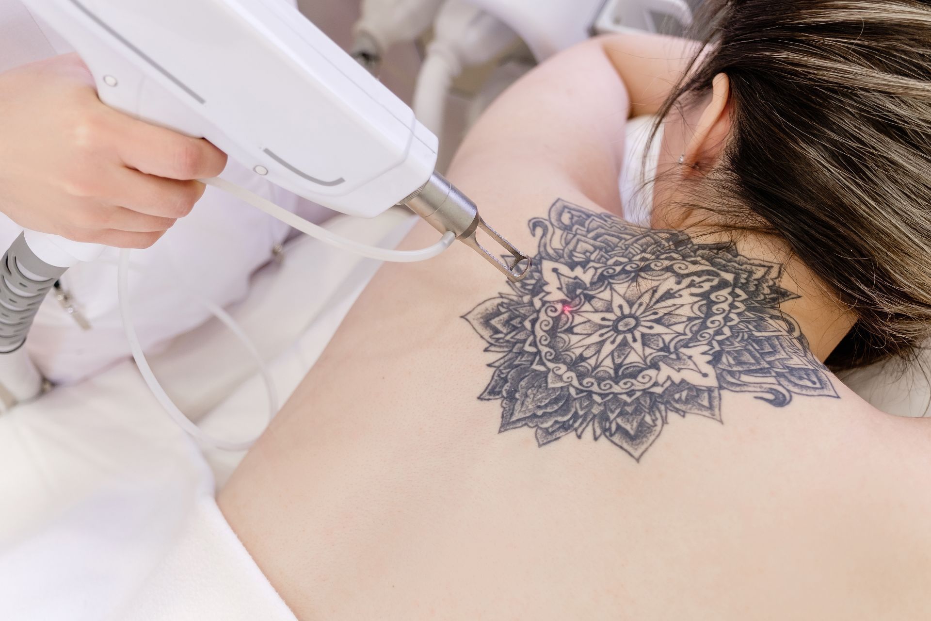 Laser tattoo removal on a person's back. A medical professional holds the device over a black tattoo on the neck.