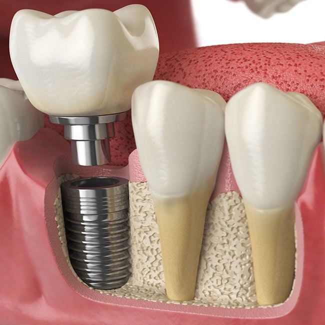 foto implantologia 3
