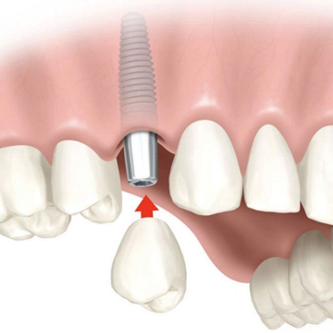 foto implantologia 2