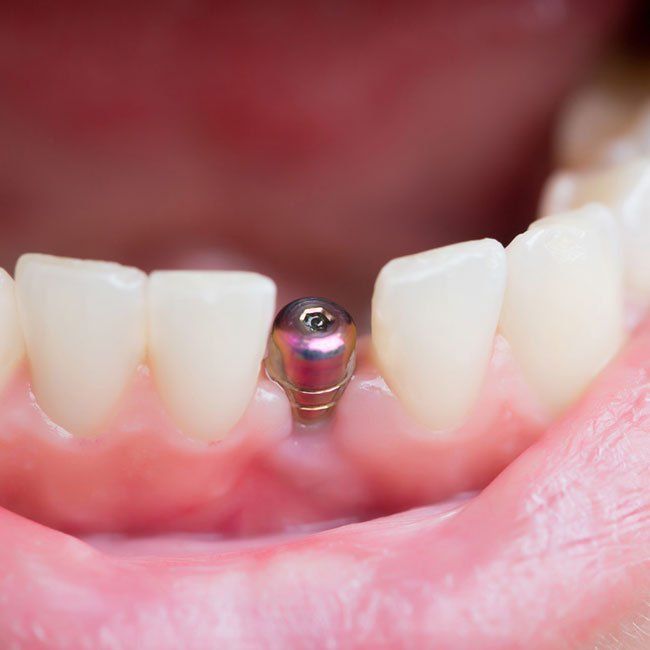 foto implantologia 1