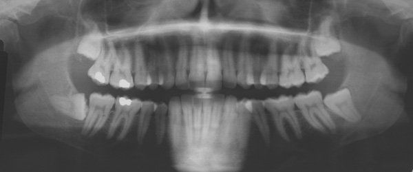 Teeth X-ray Services — Panorex X-ray in Evans, GA