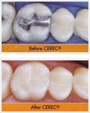 Ceramic Dental Restoration — CEREC Before &  After in Evans, GA