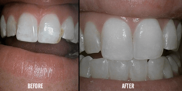 Teeth Whitening Services — Teeth Treatment in Evans, GA