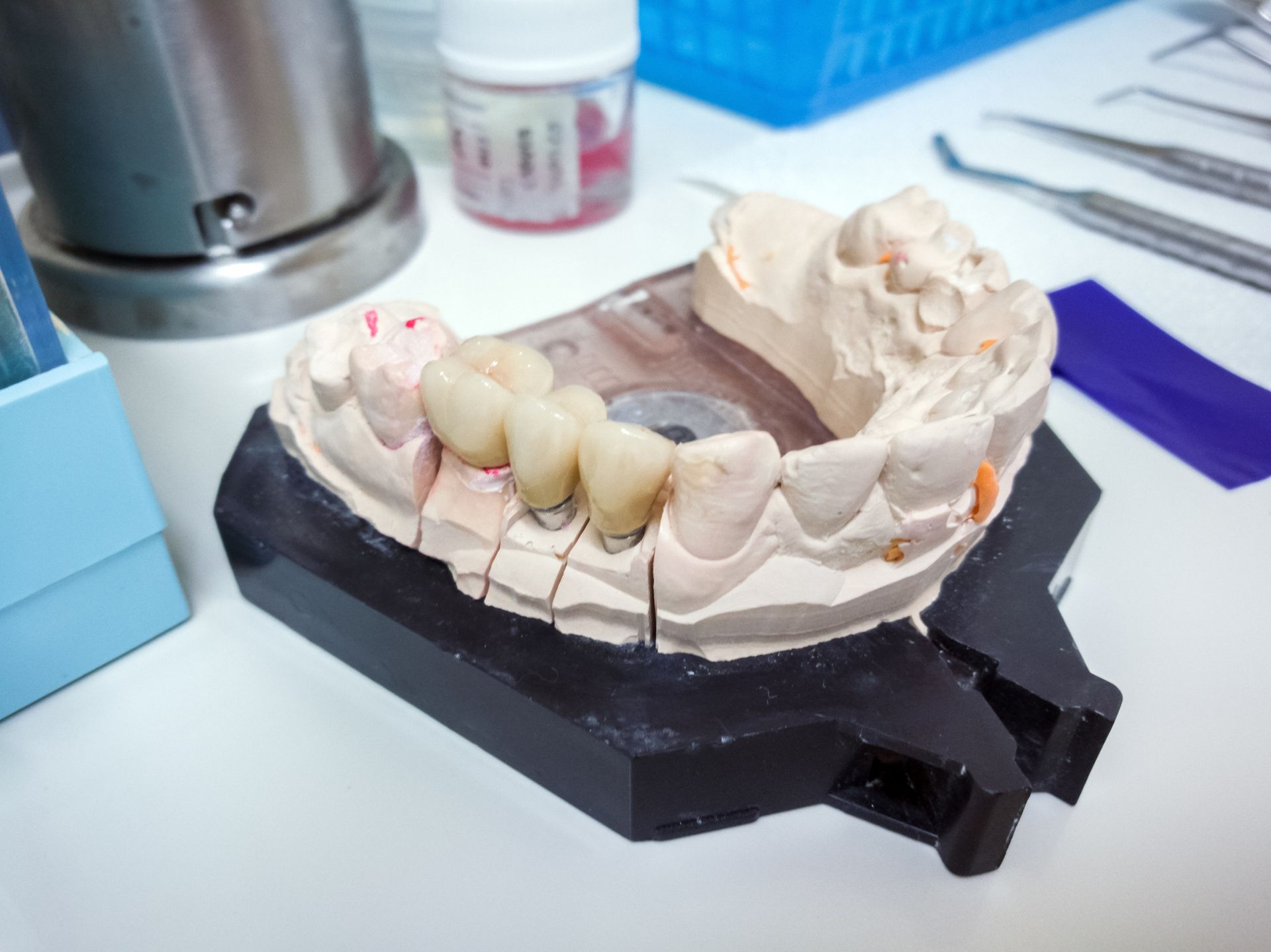 Dental crowns ready for insertion