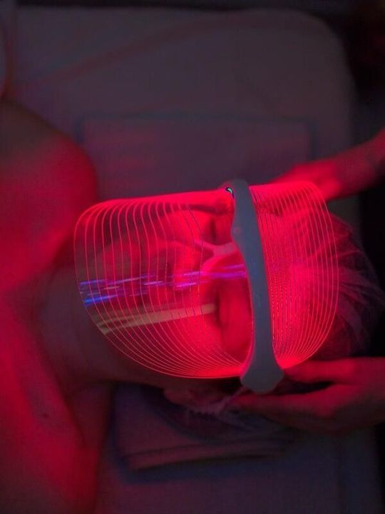 depilazione laser